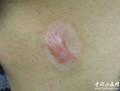 淺析放射性同位素敷貼治療方法_儀器修復(fù)_疤痕修復(fù)_中國疤痕網(wǎng) - 您身邊的疤痕修復(fù)專家